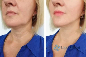 Double chin before and after Hi-Fu treatment 4 Book your double chin treatment Henley-on-Thames today! We are here to help!