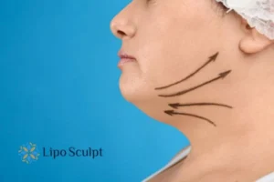 Double chin before and after Hi-Fu treatment 3 Boost your confidence with a Double chin treatment Henley-on-Thames