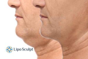 Double chin before and after Hi-Fu treatment 2 Double chin treatment Henley-on-Thames from Lipo Sculpt - feel more confident today!