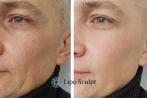 How to Fight Aging Symptoms 3 Fight Aging Symptoms Henley-on-Thames With HIFU and Morpheus8 Today!