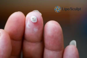 Cryopen Top 5 Treatable Conditions 4 Do you have a persistent wart of verruca that you cannot shit? Cryopen Henley-on-Thames treatment will work call us NOW!