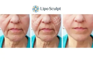 Explaining Morpheus8 And What It Can Do For You 3 Boost your confidence with Morpheus8 Henley-on-Thames call our team today!