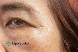 Cryopen: The Revolutionary Treatment for Age Spots Unveiled 2 Are age spots Henley-on-Thames giving you low self esteem? Contact us today!