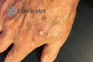 Best Actinic Keratoses Removal 2 Improve your wellbeing and health with Actinic Keratoses Henley-on-Thames removal.treatment