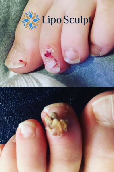 Wart removal customer results from Lipo Sculpt Henley-on-Thames