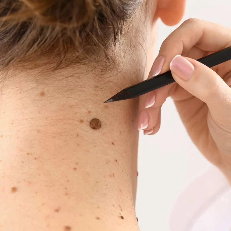How to Support Your Body During Pregnancy for Faster Postnatal Recovery 5 See our lesion removal prices Henley-on-Thames - call today for a free quote