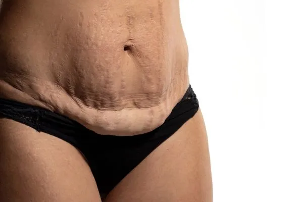 Lost the Weight but Not the Loose Skin? 1 image of womans stomach after weight loss showing loose skin Henley-on-Thames
